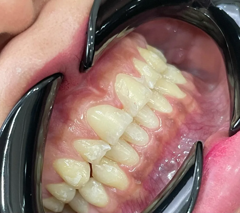 Antes: dientes desalineados antes del diseño de sonrisa en Nova Sonrisa