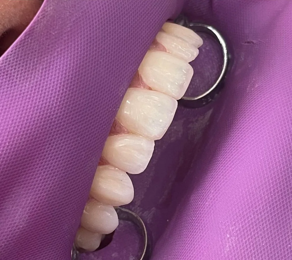 Después: sonrisa con carillas en Nova Sonrisa