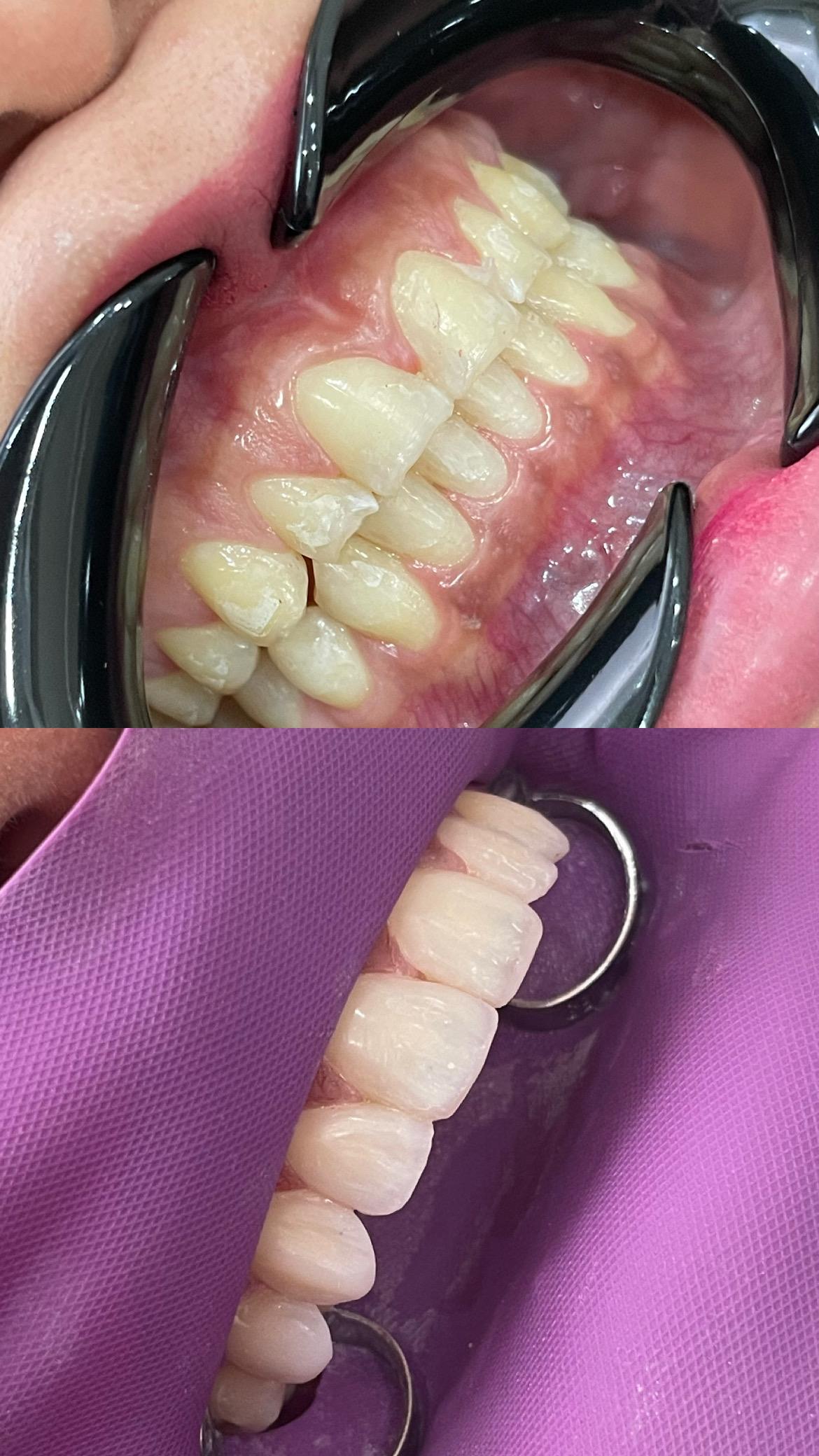 Antes y después de un diseño de sonrisa con carillas en Nova Sonrisa