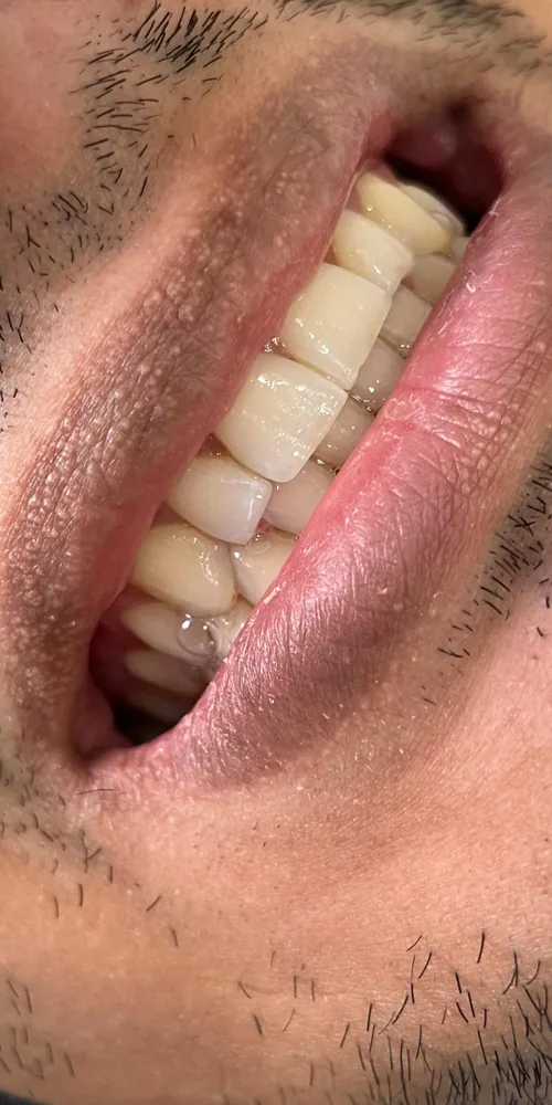 Antes: dientes con tono amarillento antes del tratamiento en Nova Sonrisa