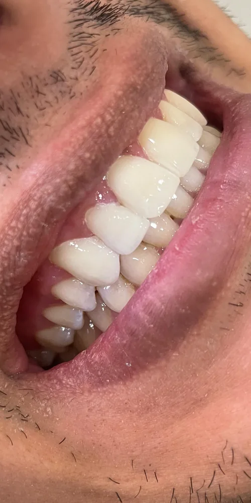 Después: dientes blanqueados y armonizados en Nova Sonrisa