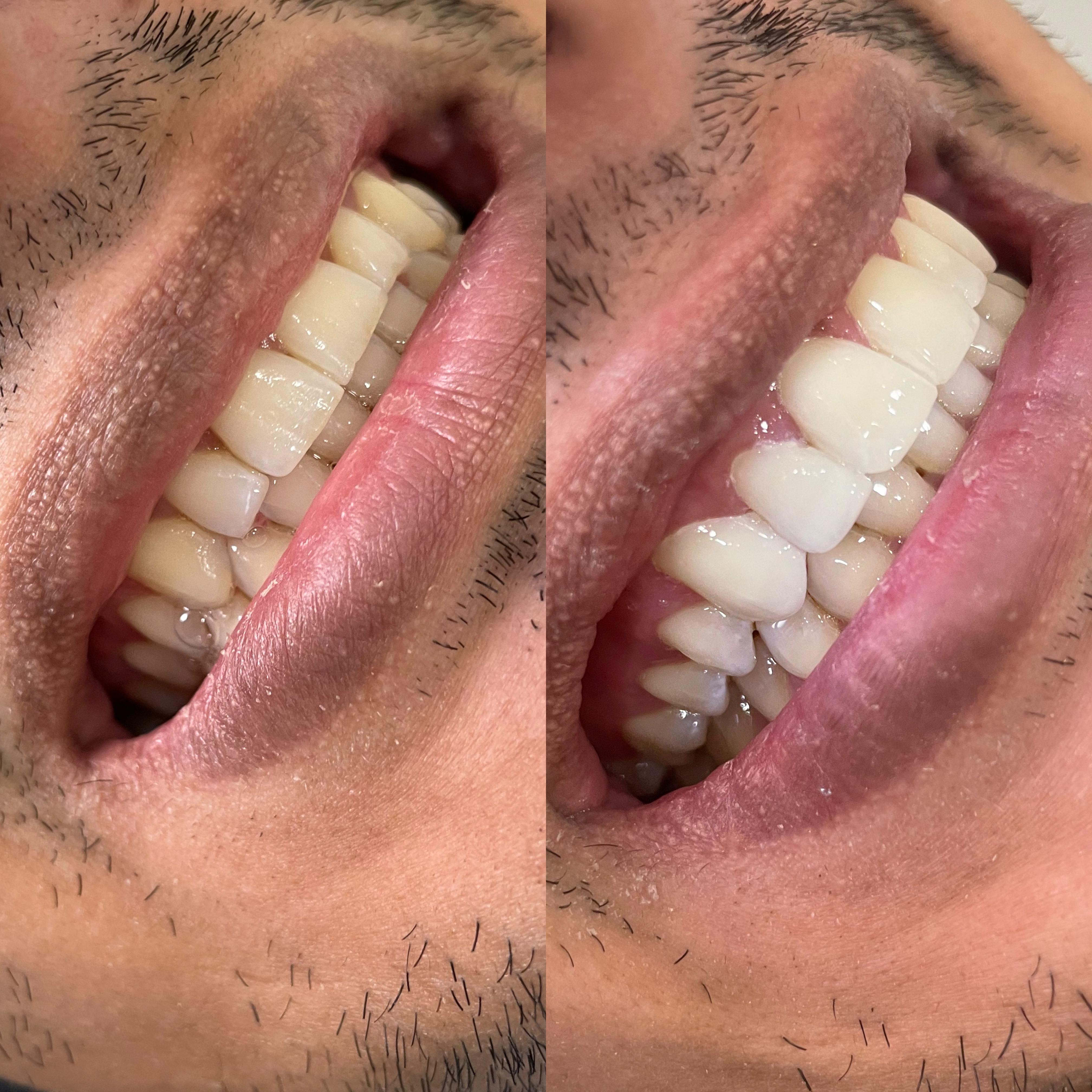 Antes y después de un tratamiento de estética dental en Nova Sonrisa