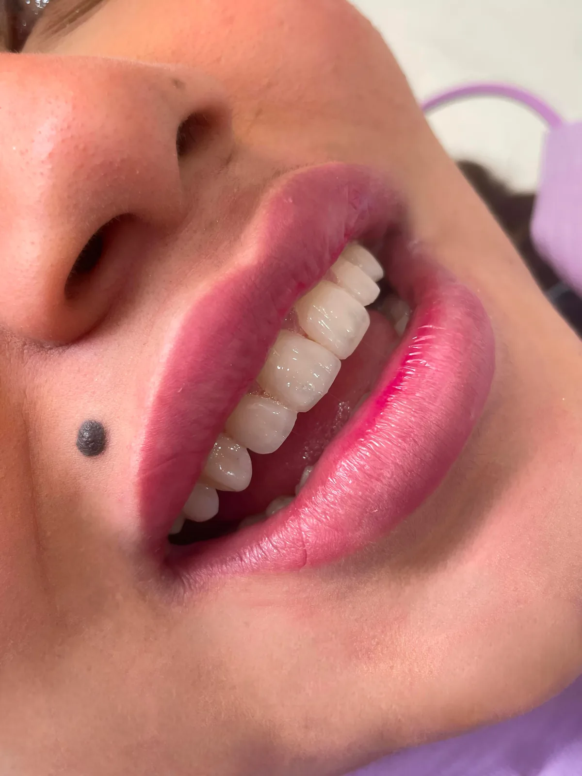 Resultado real de estética dental en Nova Sonrisa