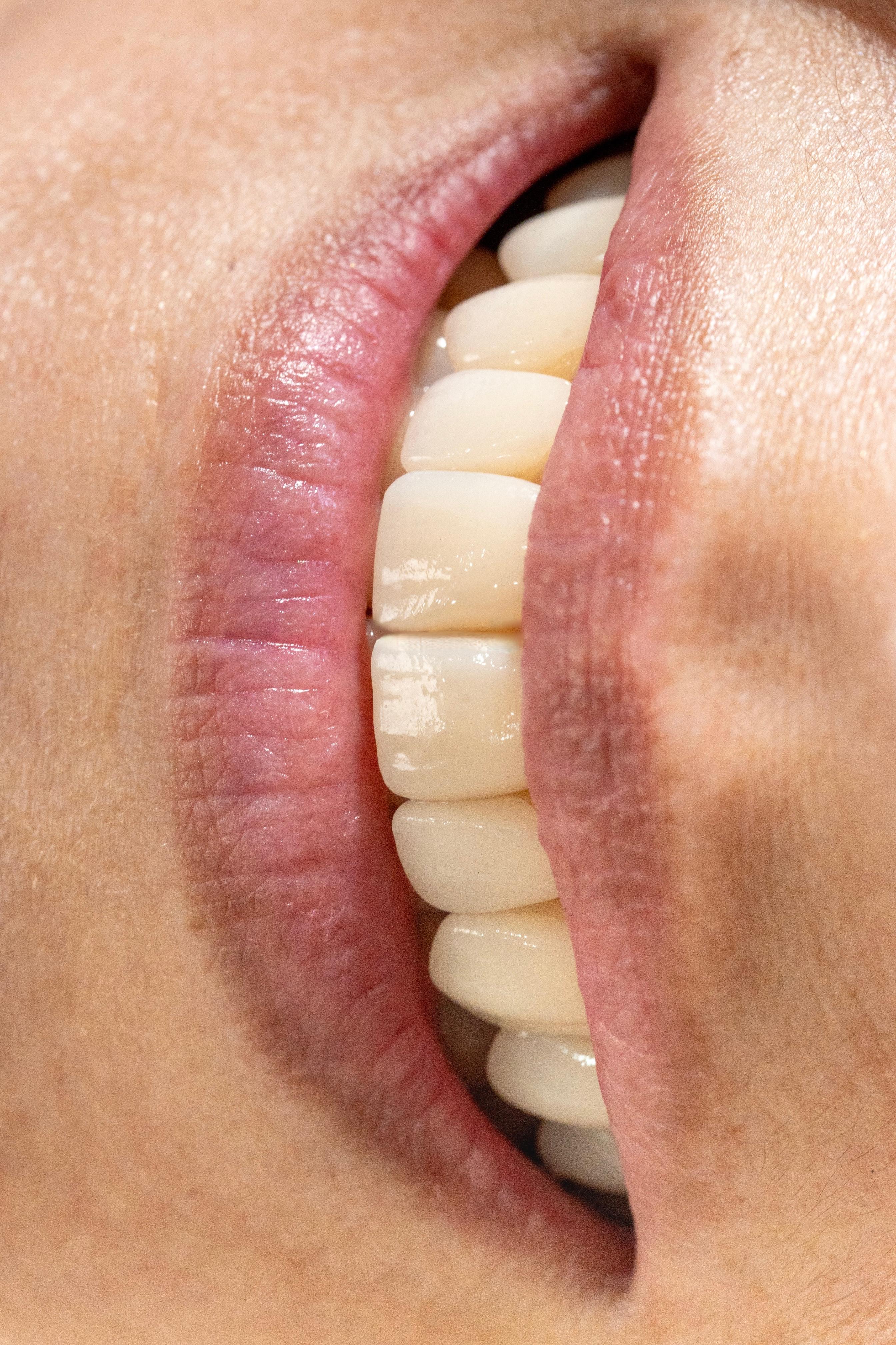 Resultado real de carillas dentales en Nova Sonrisa